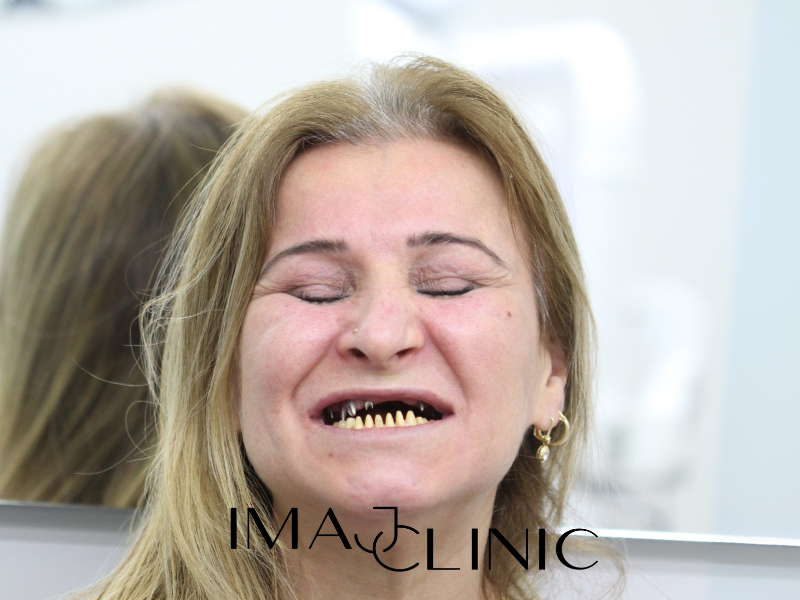 Tedavi Öncesi