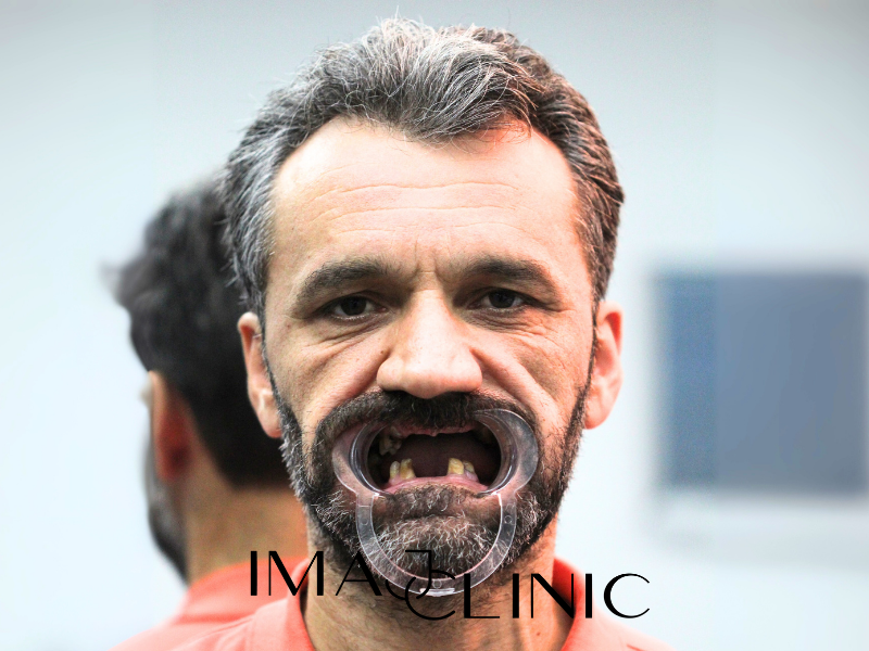 Tedavi Öncesi