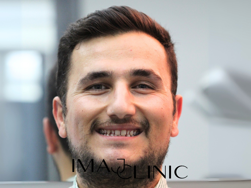 Tedavi Öncesi