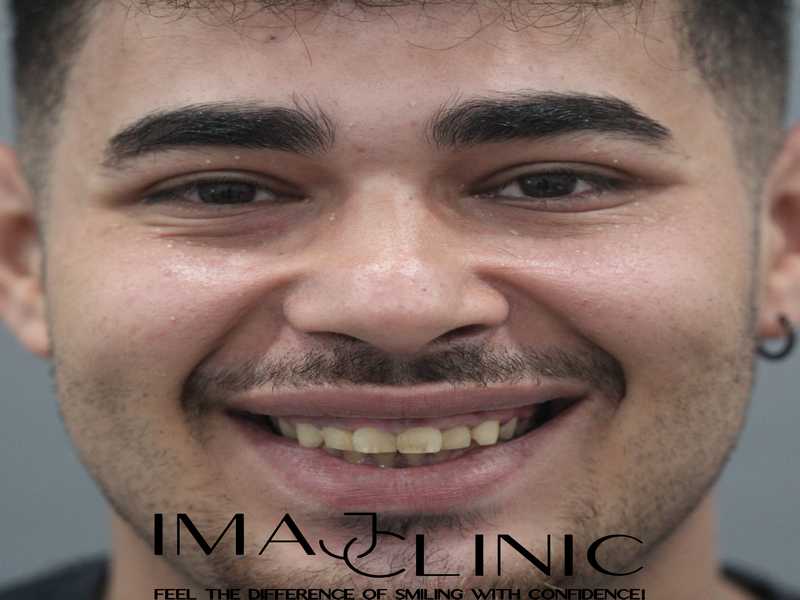 Tedavi Öncesi