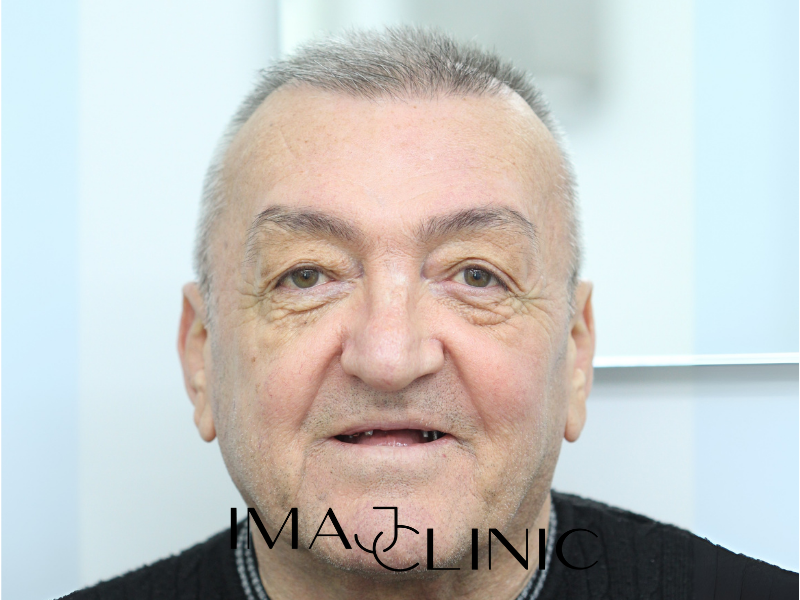Tedavi Öncesi