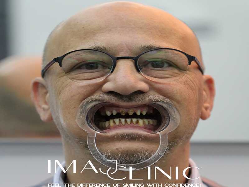 Tedavi Öncesi
