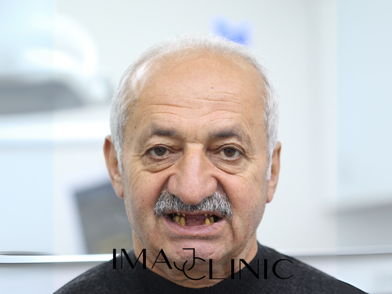 Tedavi Öncesi