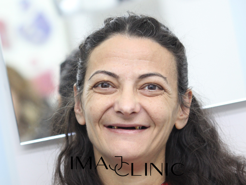 Tedavi Öncesi