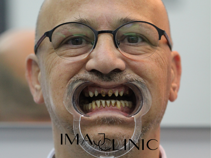 Tedavi Öncesi