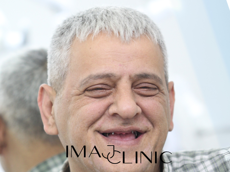 Tedavi Öncesi