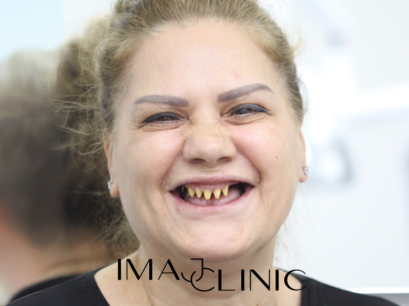 Tedavi Öncesi
