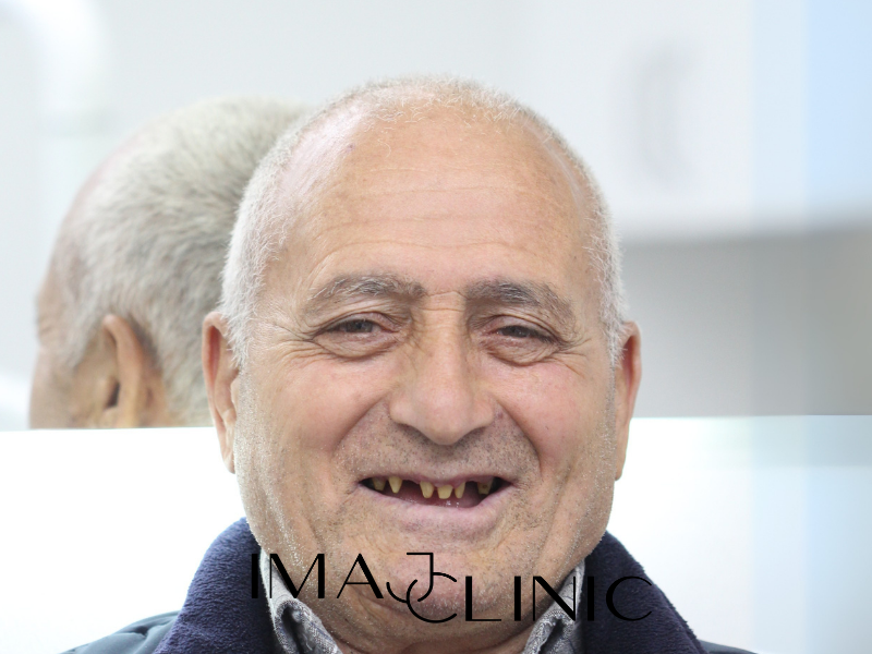 Tedavi Öncesi