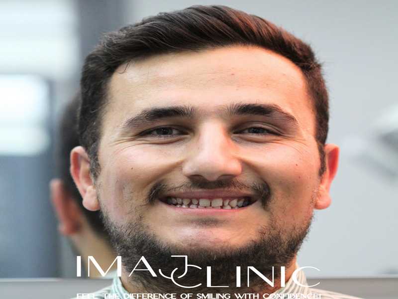 Tedavi Öncesi