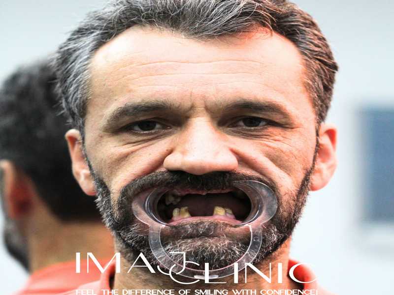 Tedavi Öncesi