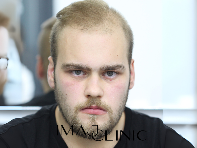 Tedavi Öncesi